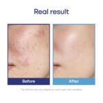 Hyalugel Plus Gel (Hyaluronic Acid Gel) - Image 8